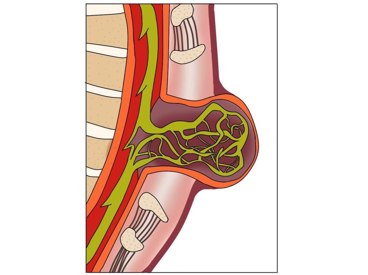 Myelomeningocele, spina bifida terbuka dengan pergeseran sumsum tulang belakang dan saraf tulang belakang.